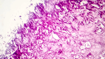 Des molécules vibrantes ont détruit 99 % des cellules cancér ... Image 1