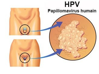 La vaccination contre le papillomavirus reconduite à la rent ... Image 1