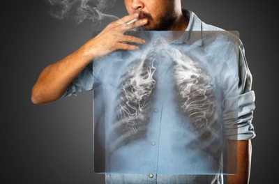 Cancer du poumon : face au tabac, tous les fumeurs ne sont p ... Image 1