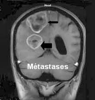 Métastases pistées par prise de sang : Gustave-Roussy ouvre  ... Image 1