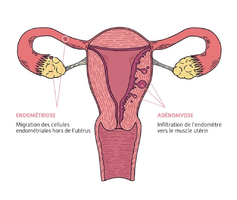 Endométriose : vers la prise en charge d’un test salivaire p ... Image 1