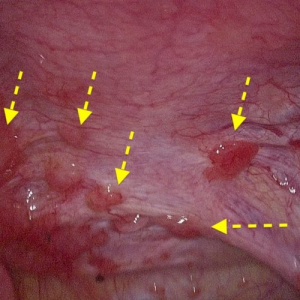 Endométriose : des tests salivaires vont être accessibles à  ... Image 1