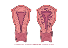 Endométriose : un test salivaire pour détecter la maladie en ... Image 1