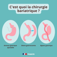 Journée mondiale contre l'obésité : que penser des nouveaux  ... Image 1