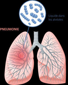 Recommandations HAS : élargir la vaccination anti-pneumococc ... Image 1