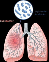 Recommandations HAS : élargir la vaccination anti-pneumococc ... Image 1