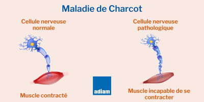 Maladie de Charcot : une potentielle cause identifiée par de ... Image 1