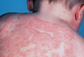 Allergies : attention aux complications si elles ne sont pas ... Image 1